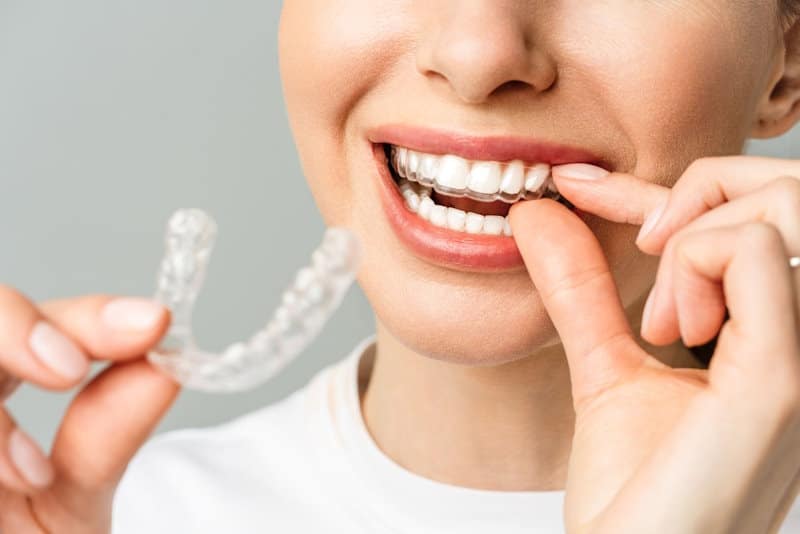 Invisalign onzichtbare beugel