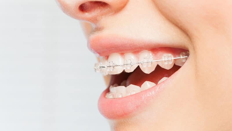 Beugels voor volwassenen - van orthodontie